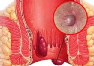 Wie sind Hämorrhoiden